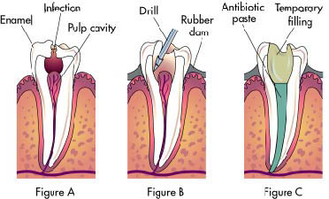 Dental Health and Root Canals 