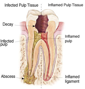 Dental Health and Root Canals 