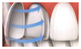 Veneers/Laminates