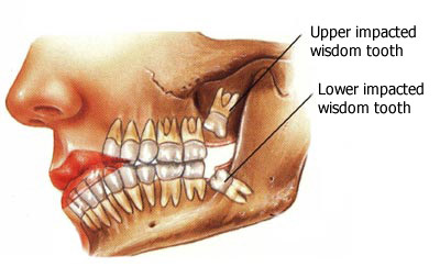 wisdom teeth removal full recovery time