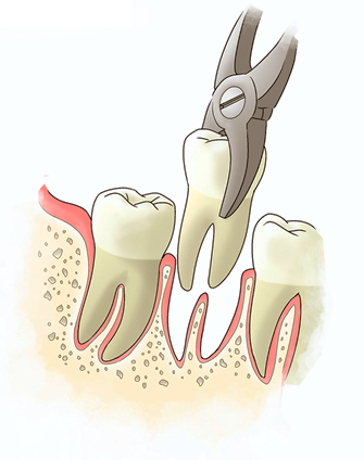 Extractions